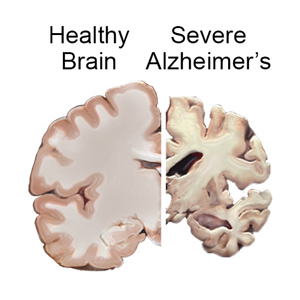 What is Alzheimer’s disease?