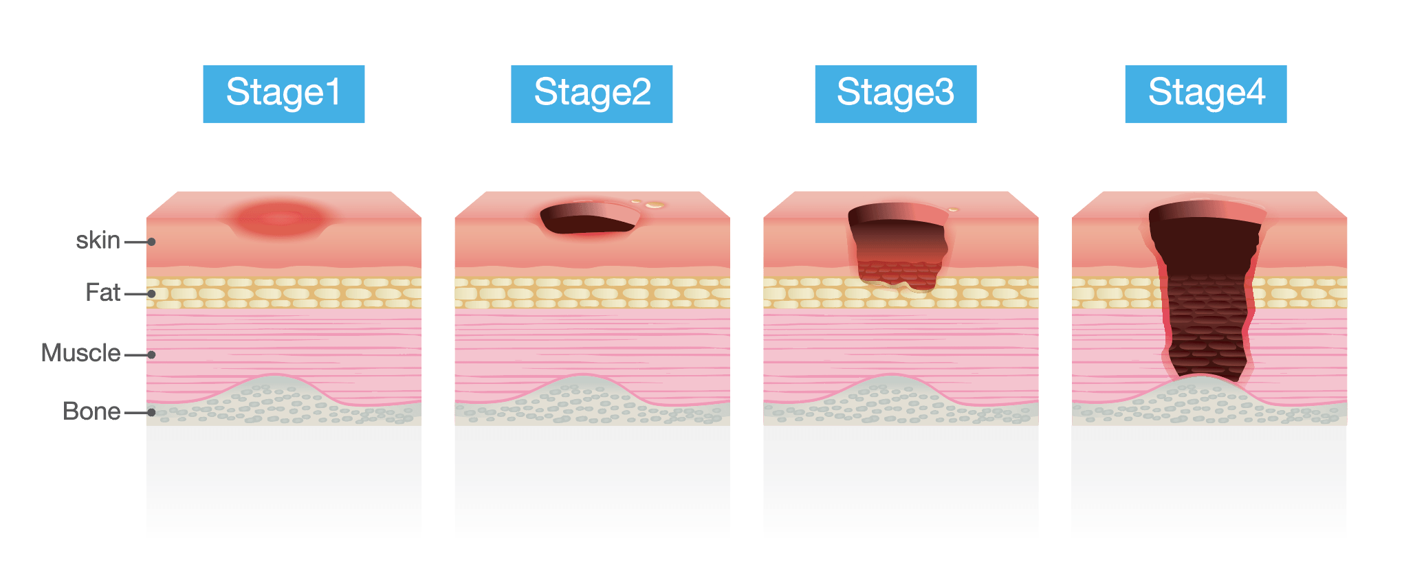 cross-section diagrams of pressure ulcer stages