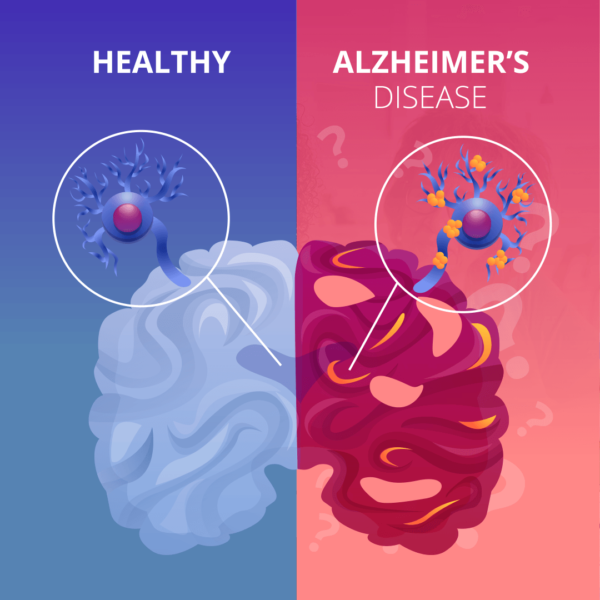 Alzheimer S Disease The Basics Alzheimer S Los Angeles