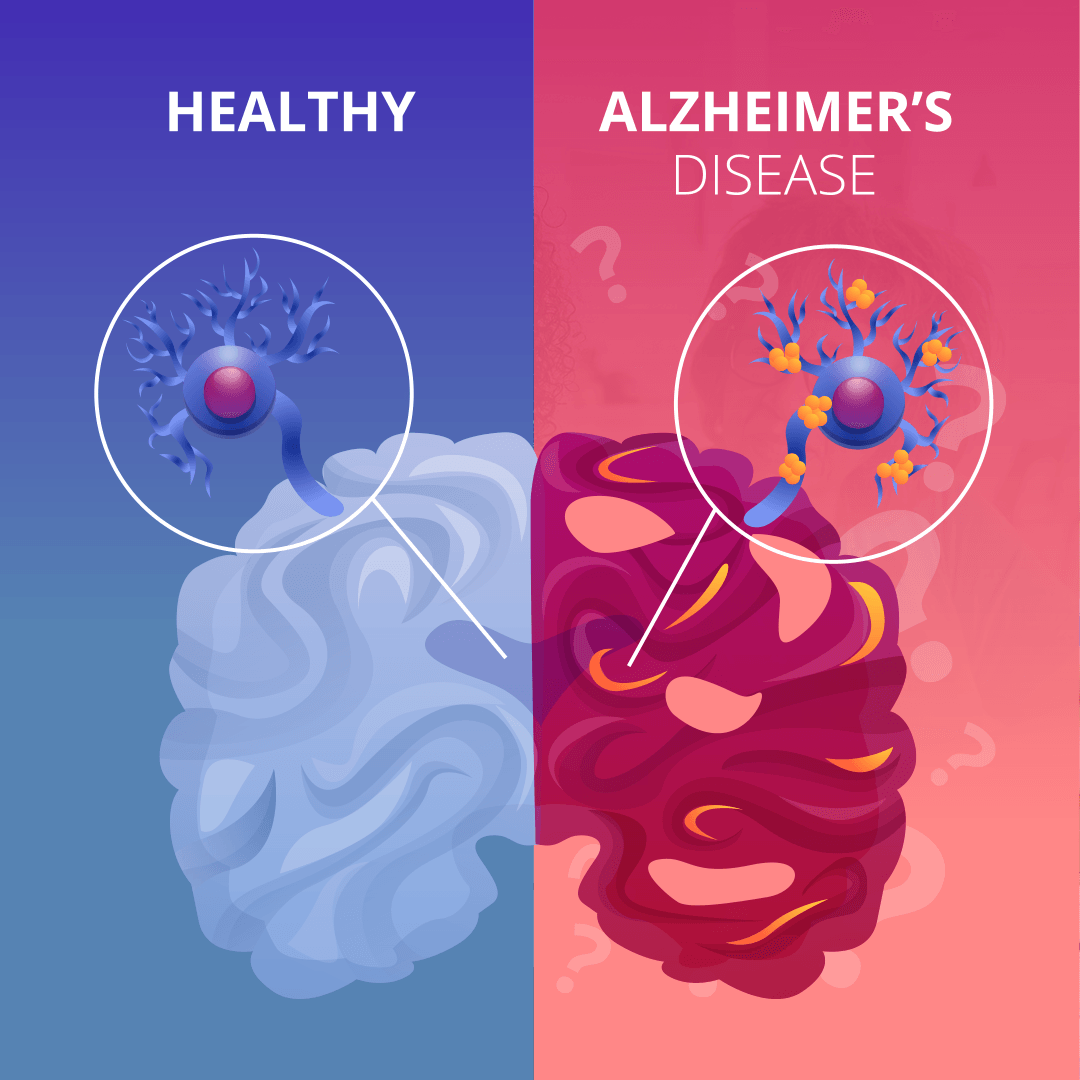 illustration showing plaques in brain with Alzheimer's disease
