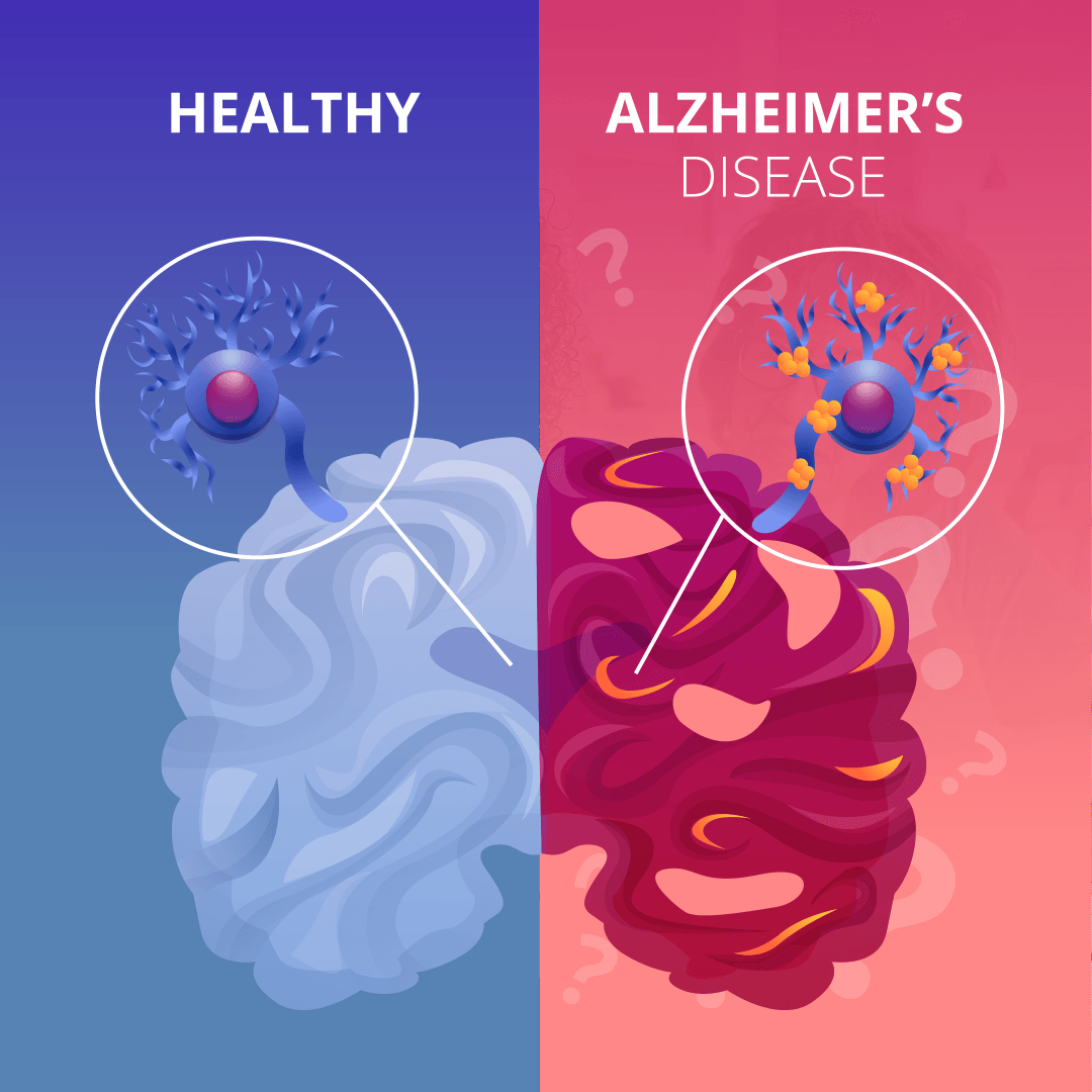 Alzheimer - JerinJordann